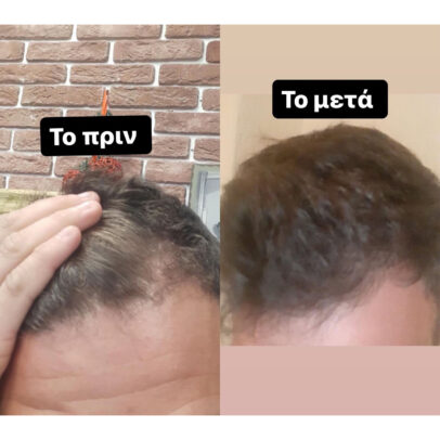 TURBO OIL. Λάδι μαλλιών για τριχόπτωση και ενδυνάμωση - Image 2